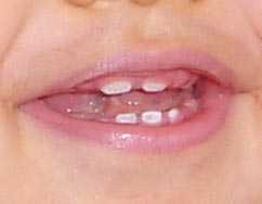 dientes_separados01.jpg