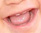 dientes_separados02.jpg