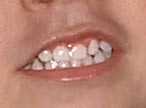 rechinar_dientes_nino.jpg