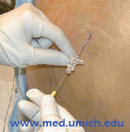 epidural-anestesia.jpg