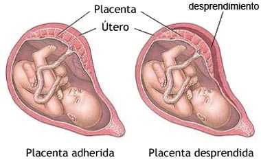 desprendimiento-placentario.jpg