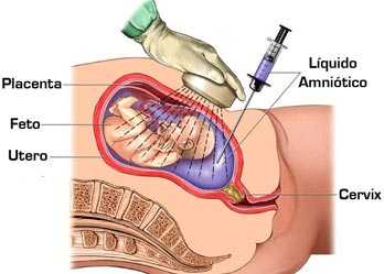 amniocentesis.jpg